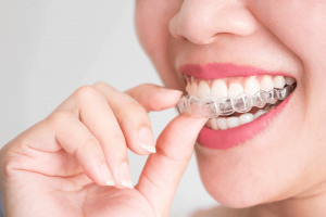 5 lucruri incredibile pe care nu le stiai despre aparatul dentar Invisalign